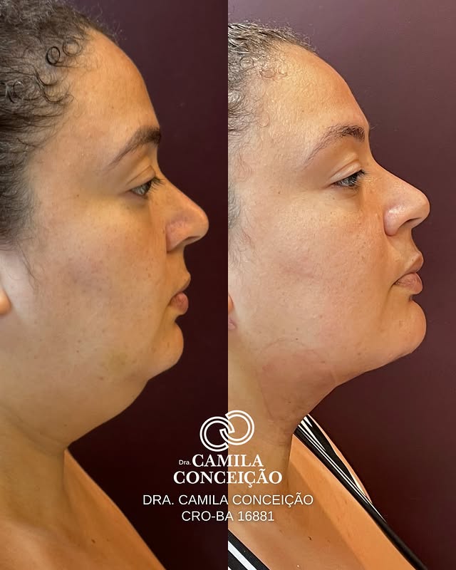 Resultado antes e depois de harmonização facial — remodelação de mandíbula e pescoço