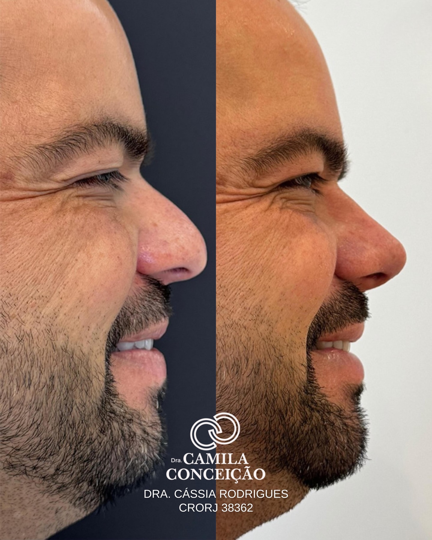 Resultado antes e depois — harmonização nasal masculina