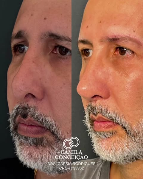 Resultado antes e depois — harmonização facial masculina